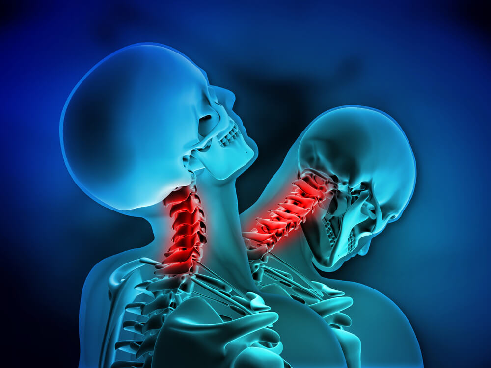 Medical Illustration of human skeletal having whiplash injury.