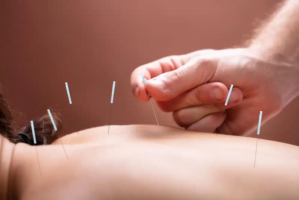 A person getting the acupuncture therapy